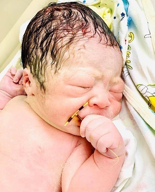 Em bé chào đời nắm chặt vòng tránh thai của mẹ