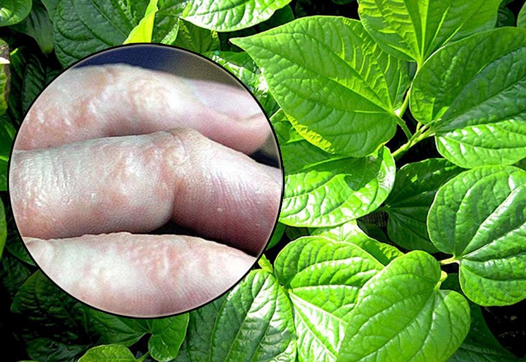 Một số bài thuốc dân gian chữa bệnh tổ đỉa