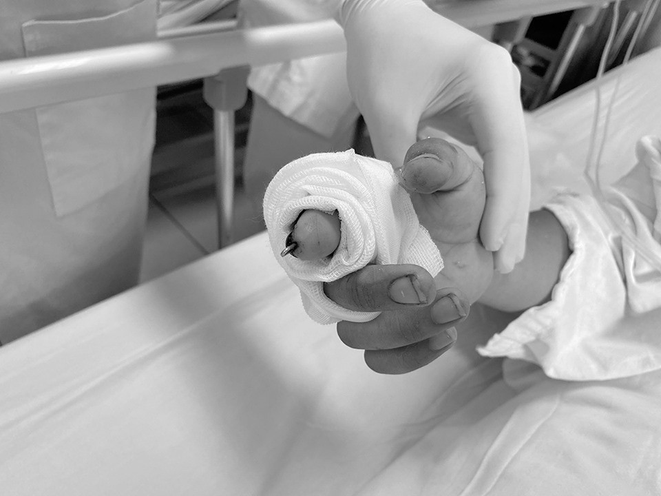 Ngón tay của bé sau khi được nối lại, đầu chi hồng ấm và có dấu hiệu phục hồi tốt. Ảnh: Bệnh viện cung cấp.