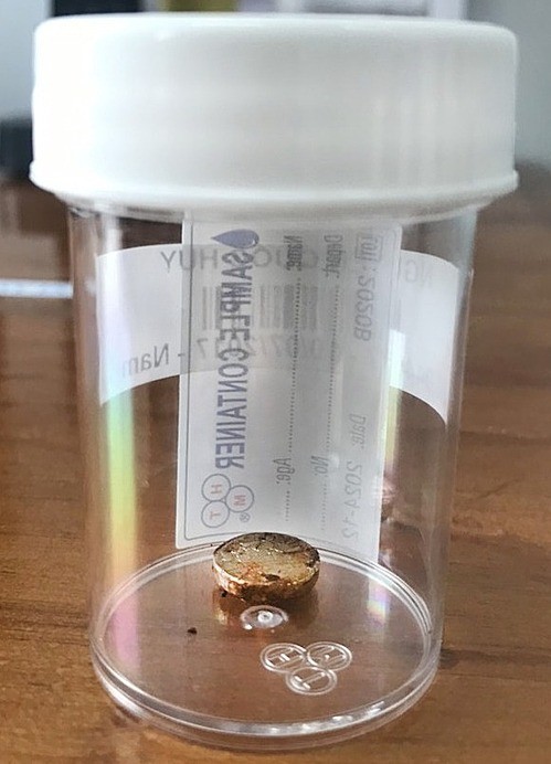 Viên pin phá hủy hốc mũi bé trai