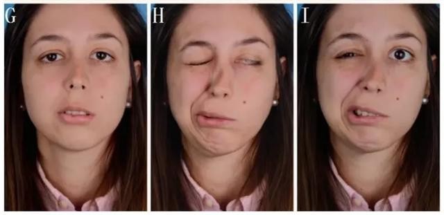 Bị liệt mặt do bật quạt thổi thẳng vào mặt suốt đêm. (Ảnh minh họa)