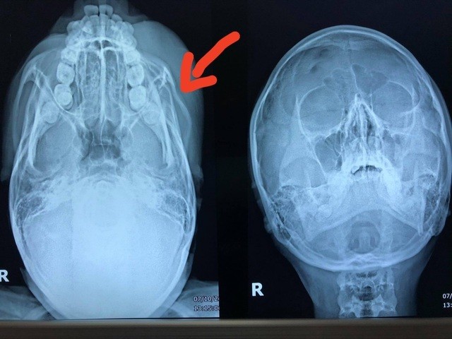 Áo chống nắng cuốn vào bánh xe, thiếu nữ ngã đập mặt