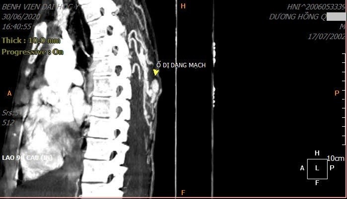 Tưởng mụn hóa búi dị dạng động tĩnh mạch