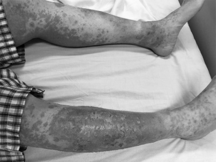 Vảy nến thể mủ trên chân của bệnh nhân trước điều trị. Ảnh: Lan Anh.