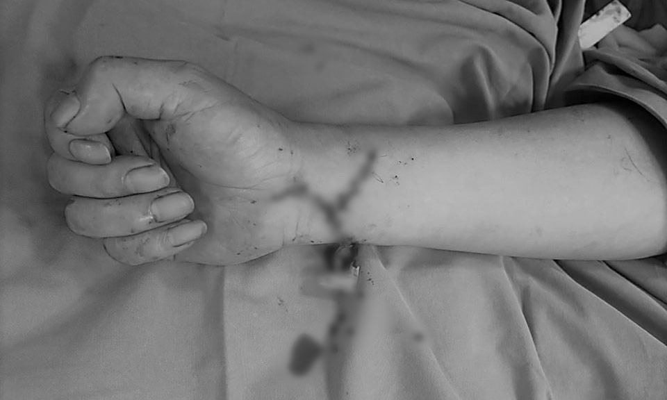 Bàn tay của người đàn ông sau mổ. Ảnh: Bệnh viện cung cấp.