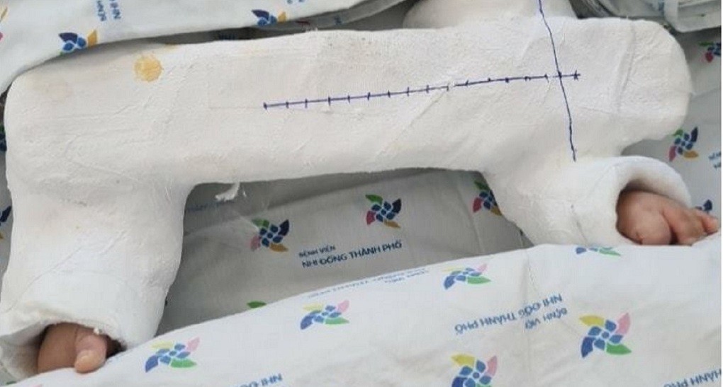 Việc bó bột giúp hai bé khép và duỗi thẳng chân song song, đồng thời giúp việc chăm sóc tầng sinh môn sau hậu phẫu dễ dàng hơn. Ảnh Bệnh viện cung cấp