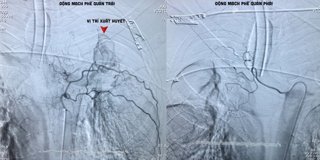 Hình ảnh động mạch phế quản bệnh nhân bị vỡ, gây xuất huyết, nôn ra máu. Ảnh Bệnh viện cung cấp