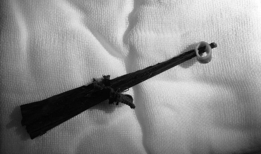 Bác sĩ phẫu thuật phải cắt bỏ một phần tĩnh mạch, động mạch mới lấy được thanh gỗ ra ngoài. Ảnh Bệnh viện cung cấp.