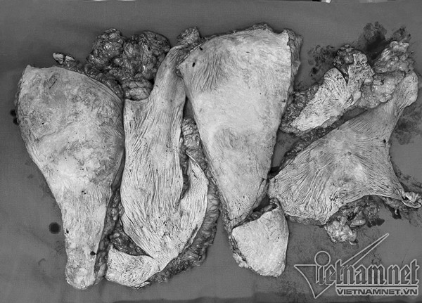 Phần da thừa được cắt bỏ sau ca phẫu thuật