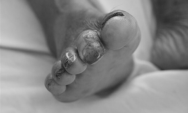 Vì sao số ca Whitmore tăng?