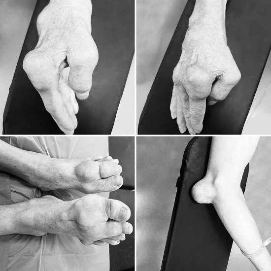 Hình ảnh tứ chi biến dạng của bệnh nhân trước phẫu thuật. Ảnh: Bệnh viện cung cấp