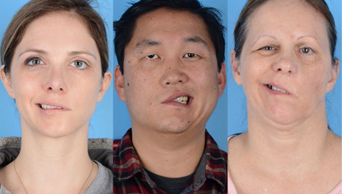 Biểu hiện liệt dây thần kinh số 7