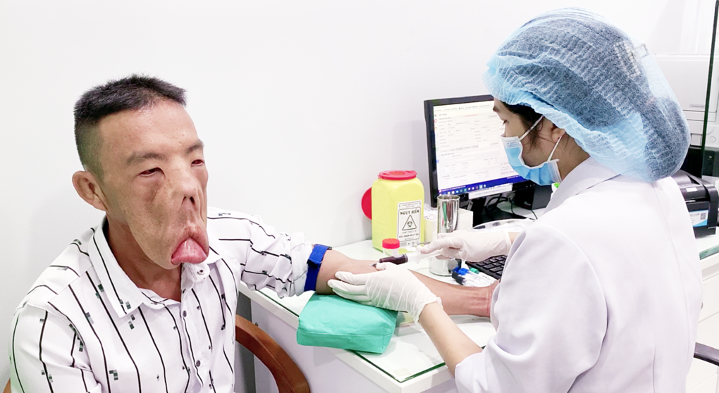 Trước mổ, khuôn mặt anh Mến biến dạng nặng suốt 15 năm. Ảnh: Hải Đăng.