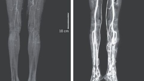 Thuốc trị đau nửa đầu của người phụ nữ gây căn bệnh kỳ quái vào thời trung cổ