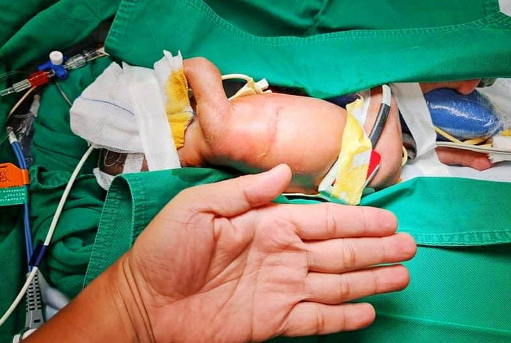 Sửa đa dị tật tiêu hóa cho bé gái sinh non