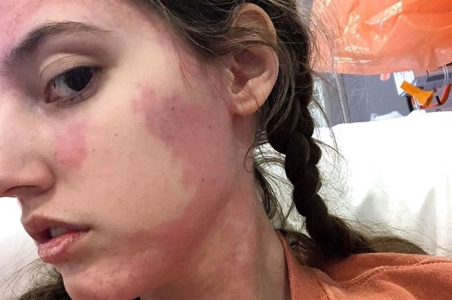 Căn bệnh cực hiếm khiến cô gái dị ứng với mọi loại thức ăn, sống bằng cách truyền tĩnh mạch