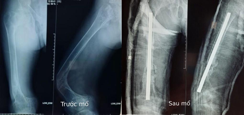 Xếp lại xương đùi cho chàng trai 'thủy tinh'
