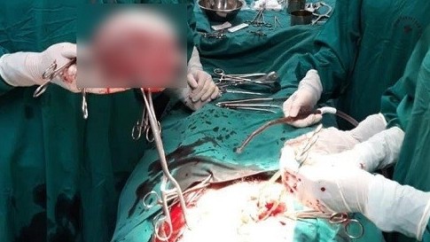 Tưởng béo bụng ai ngờ mang khối u tương đương thai 24 tuần