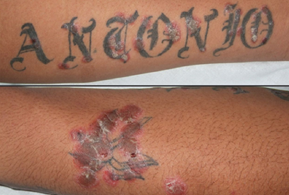 Một bệnh nhân có tổn thương vảy nến xuất hiện nhiều hơn ở các vị trí sau xăm hình- Ảnh: BSCC