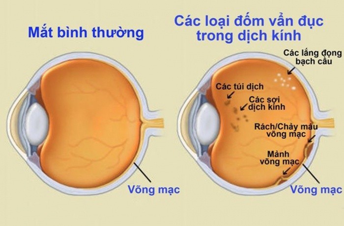 Hiện tượng “ruồi bay” trong mắt có nguy hiểm?