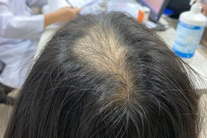 Bé gái mắc hội chứng nghiện giật tóc