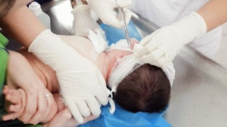 Bát mì tôm đổ vào mặt bé 12 tháng tuổi