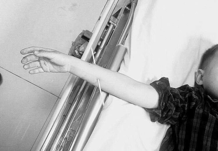 Que xiên thịt đâm xuyên cánh tay em bé