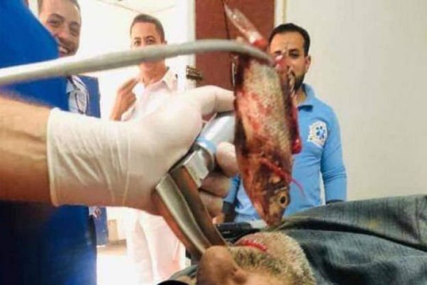 Con cá còn sống được khắp ra khỏi cổ họng bệnh nhân