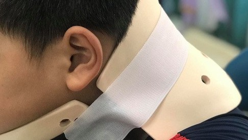 Bé trai 10 tuổi vẹo cổ vì bắt chước video nhào lộn trên mạng