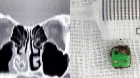 Sinh thiết phát hiện dị vật quen thuộc trong mũi bé trai 6 tuổi