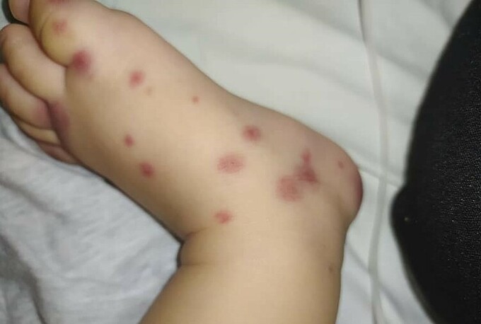 Mảng xuất huyết ở chân bé kèm sưng nề, đau. Ảnh: Bệnh viện cung cấp