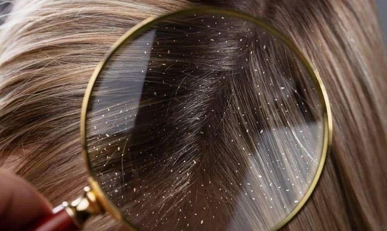 Chữa gàu da đầu