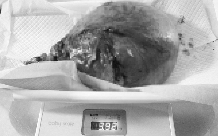 Khối u xơ tử cung nặng gần 4 kg