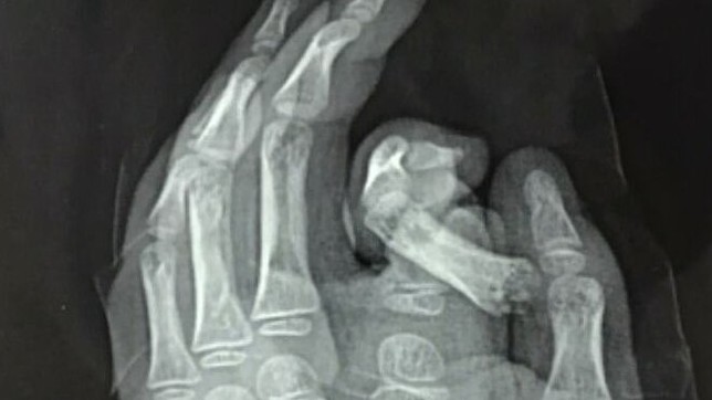 Đút tay vào máy giặt, bé trai đứt ngón trỏ