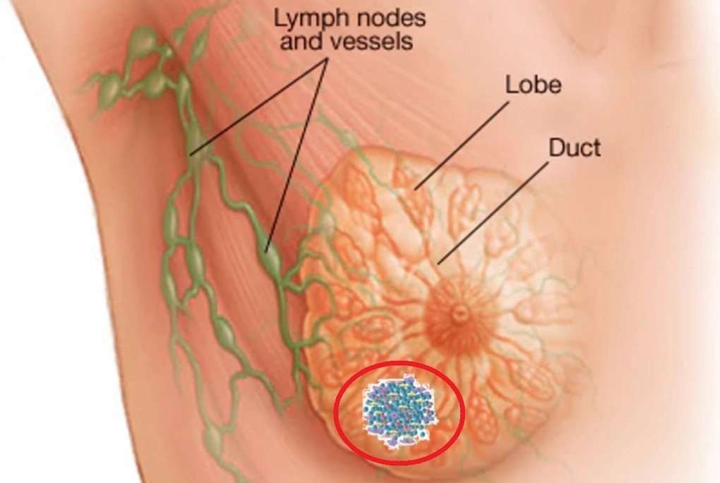 Mô phỏng khối ung thư vú. Ảnh: Bệnh viện cung cấp.