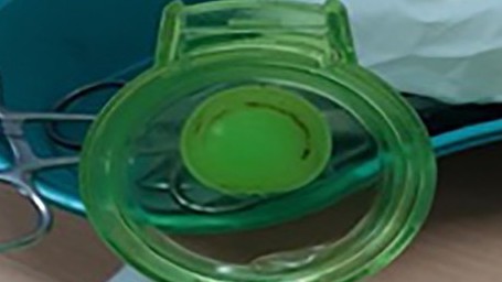 Bé gái bị kẹt lưỡi trong bình nước uống