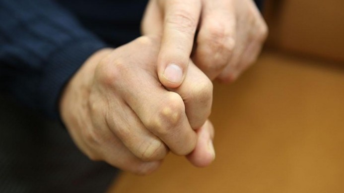 Bệnh gút ngày càng "trẻ hóa", không chữa kịp thời thì hậu quả vô cùng nghiêm trọng