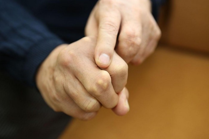 1. Gây khuyết tật khớp

Người bệnh gút nếu không kiêng kỵ và điều trị sẽ khiến các cơn đau tái phát nhiều lần, không chỉ gây đau nhức mà còn phá hủy, làm biến dạng khớp dẫn đến khuyết tật và tàn phế.