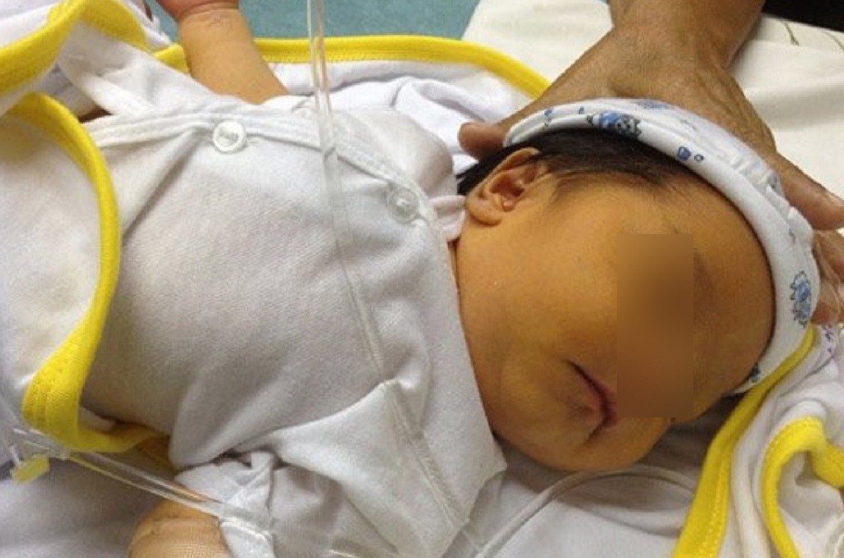 Trẻ sơ sinh bị vàng da - Hình minh họa