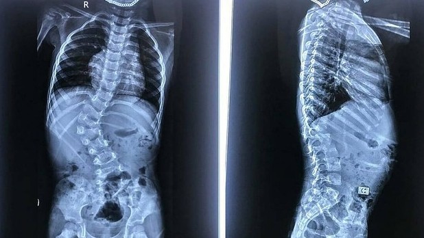 Bé trai 3 tuổi cột sống cong 66 độ