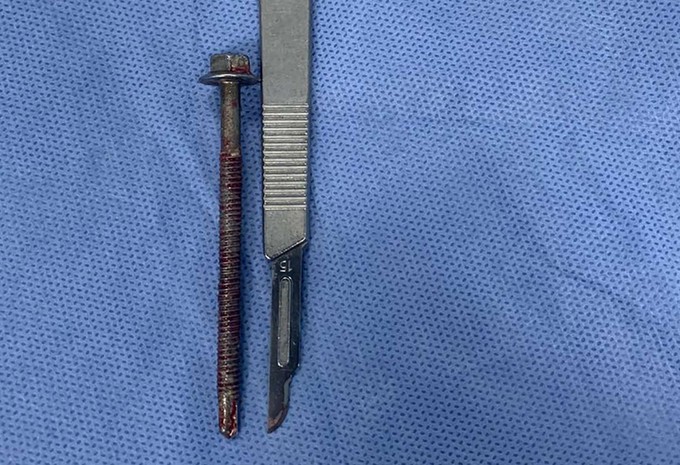 Chiếc đinh vít được bác sĩ Bệnh viện Bình Dân lấy ra khỏi đường tiểu bệnh nhân. Ảnh: Trần Nhung.