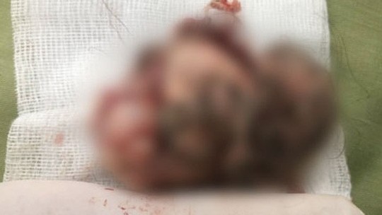 U quái chứa đầy tóc, răng, xương hàm