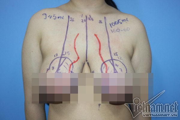 Bệnh nhi bị phì đại tuyến vú khổng lồ khiến em luôn mặc cảm, không dám tham gia các môn thể dục ở trường