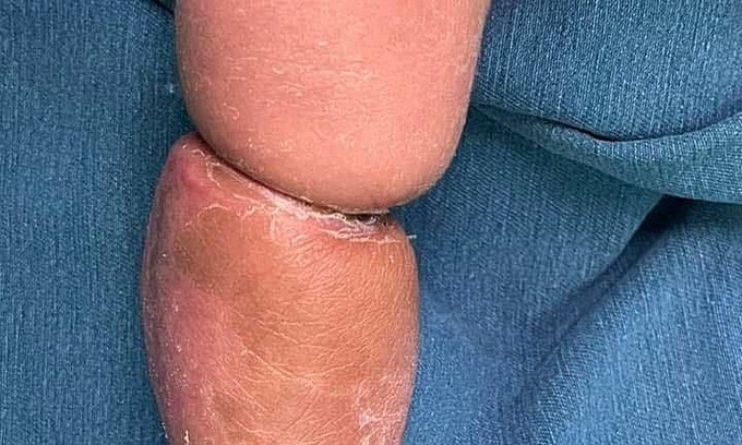 Dải sợi ối siết cẳng chân bệnh nhi. Ảnh: Lương Hiếu.