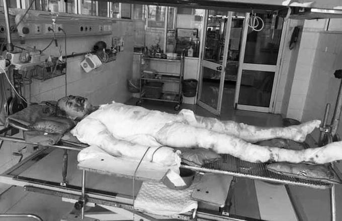 Mai khi điều trị tại Viện Bỏng Quốc gia Lê Hữu Trác. Ảnh: Nhân vật cung cấp