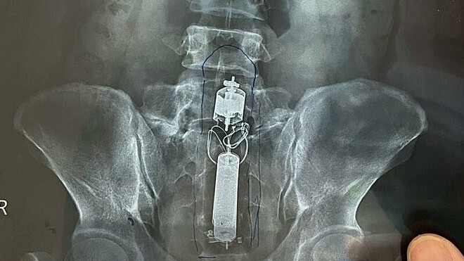 Người đàn ông mắc kẹt dương vật giả trong trực tràng