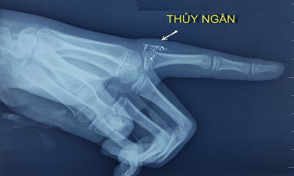 Thuỷ ngân trong ngón tay bệnh nhi. Ảnh: Bác sĩ cung cấp.