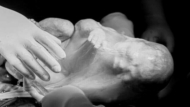 Một bé song sinh chào đời trong bọc ối