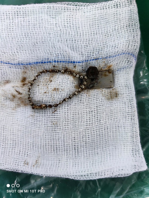 Dị vật sau khi được loại bỏ khỏi ruột bé trai