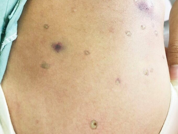 Vết ong đốt trên người bệnh nhân. Ảnh: Bệnh viện cung cấp.